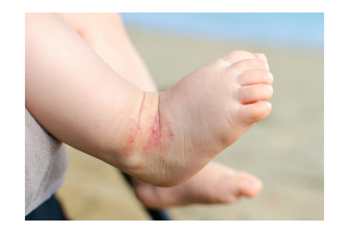 Atopický ekzém a co na něj pomáhá