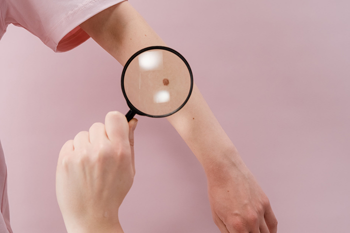 Jak poznat melanom a jak se před ním chránit
